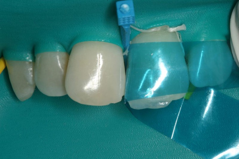 Dental Blue Strip M8 Contoured Anterior Matrix Restoration Matrices 0.05mm gallery