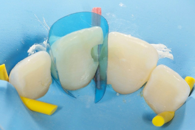 Dental Blue Strip M8 Contoured Anterior Matrix Restoration Matrices 0.05mm gallery