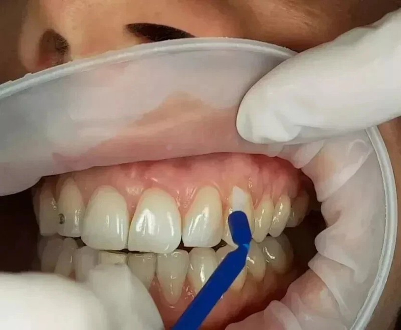 Denpro Cavity Varnish with Flouride 15gm For Dental Use (FREE & FAST SHIPPING).. gallery