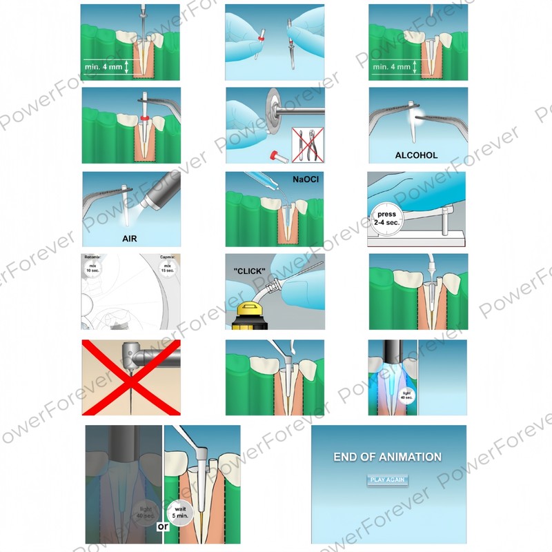 Dental Glass Fiber Post Endo Drill Root Canal Posts Fits 3M 3D ESPE RelyX gallery