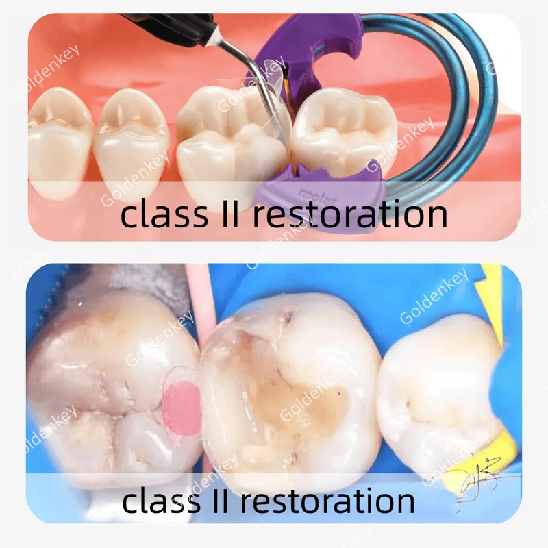 Dental Clear Matrix Posterior Transparent BT Matrices Fits Bioclear 4.5/5.5/6.5 gallery
